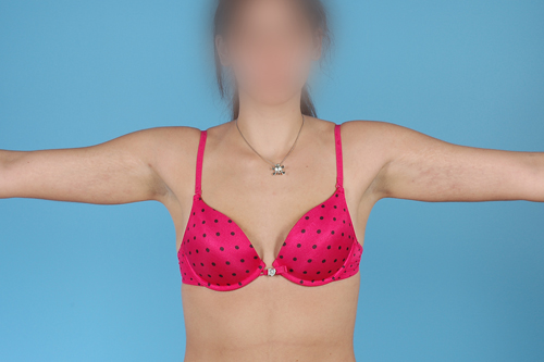 Arm Liposuction Before and After tid129