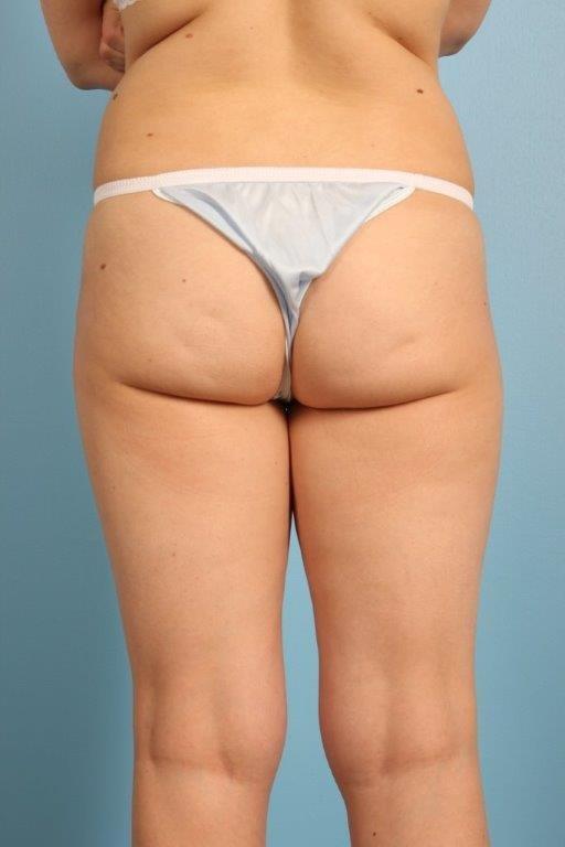Cellfina Cellulite Reduction Before and After utmsourc