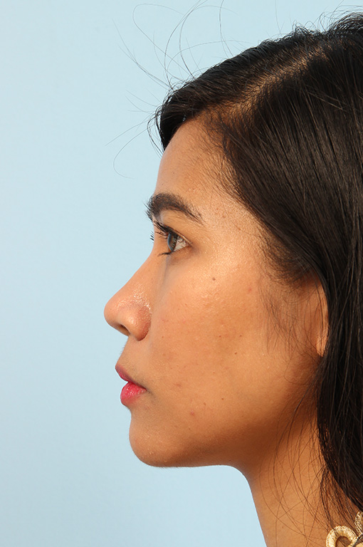 Rhinoplasty Before and After tid93