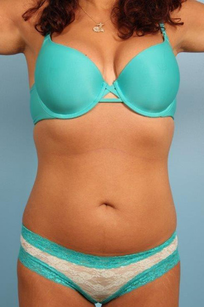 Coolsculpting Before and After utmsourc