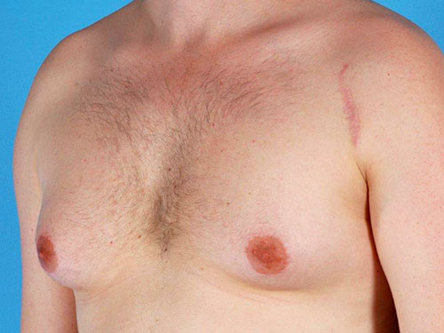 Gynecomastia Before and After 01