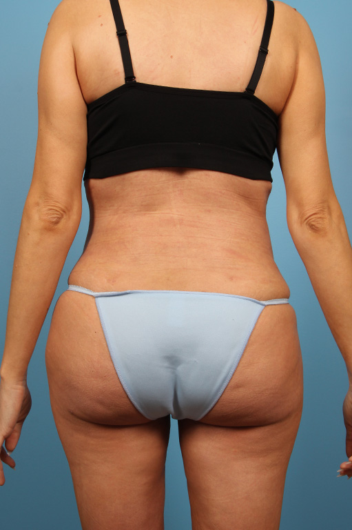 Buttock Augmentation Before and After 06
