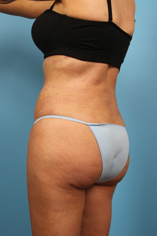 Buttock Augmentation Before and After 01