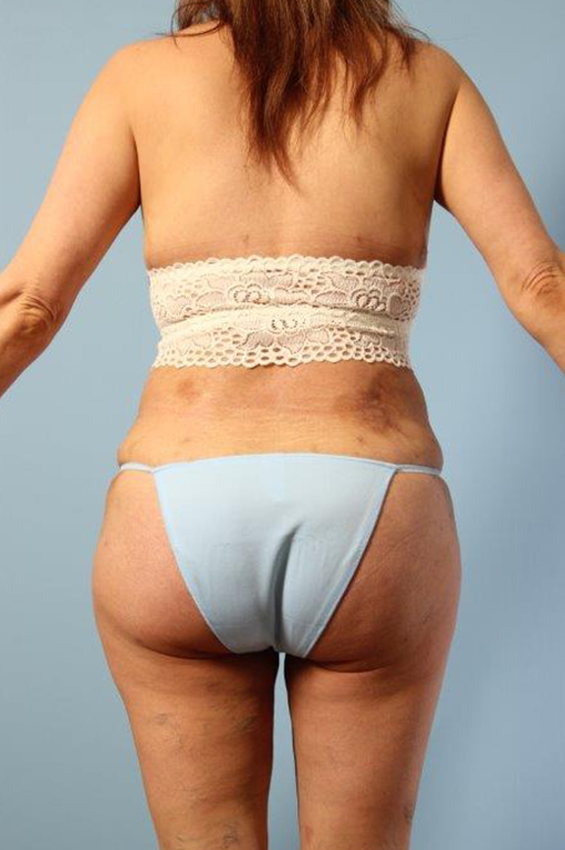 Buttock Augmentation Before and After 06