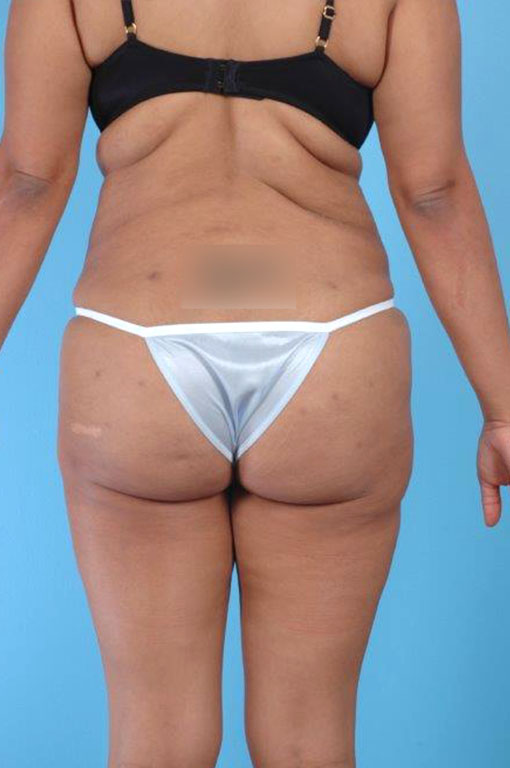 Buttock Augmentation Before and After 07