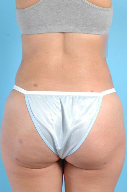 Buttock Augmentation Before and After 20