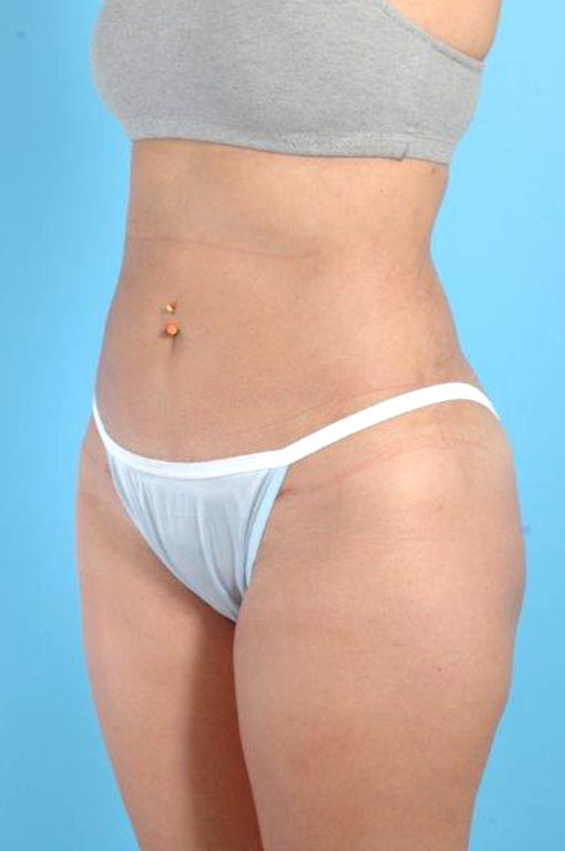 Buttock Augmentation Before and After 09