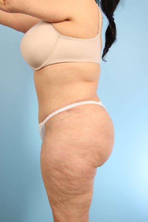 Buttock Augmentation Before and After 10