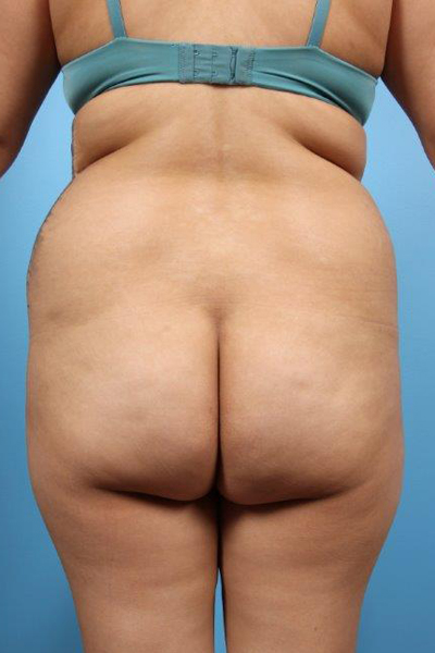 Buttock Augmentation Before and After 11