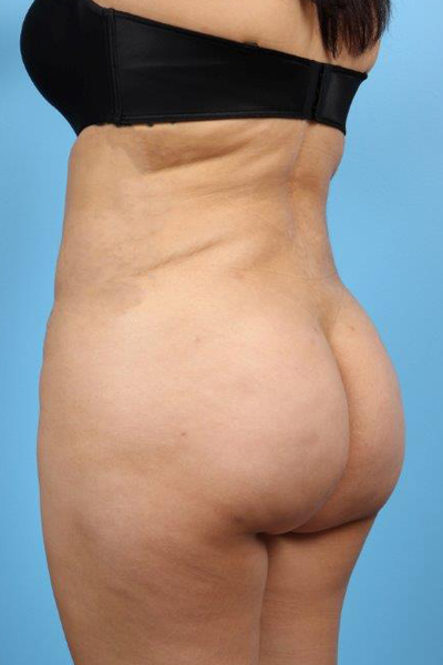 Buttock Augmentation Before and After 11