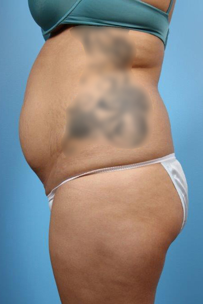 Buttock Augmentation Before and After 11