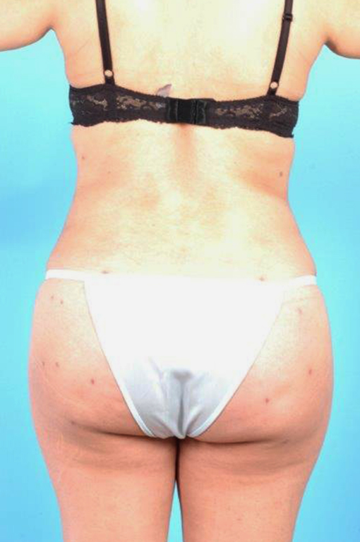 Buttock Augmentation Before and After 08