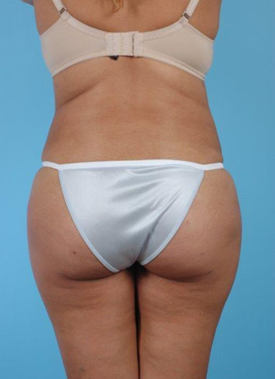 Buttock Augmentation Before and After 17