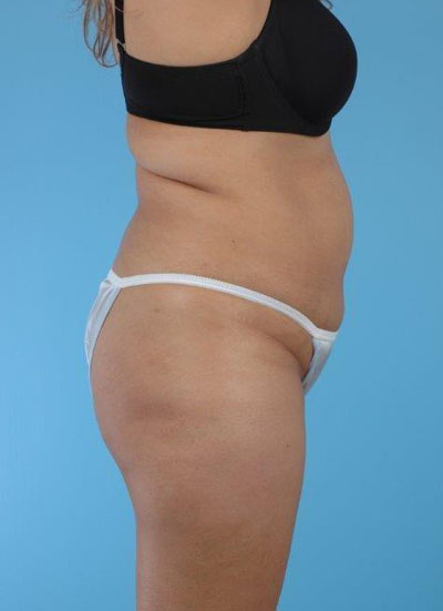 Buttock Augmentation Before and After 14