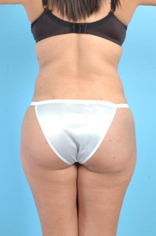 Buttock Augmentation Before and After 14