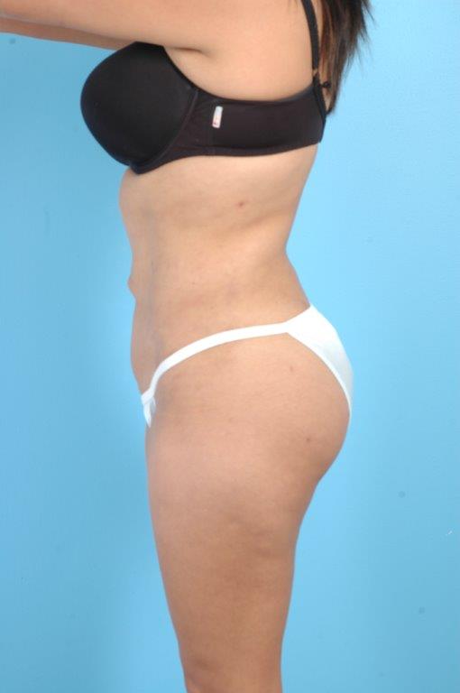 Buttock Augmentation Before and After 15