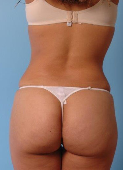 Buttock Augmentation Before and After 17