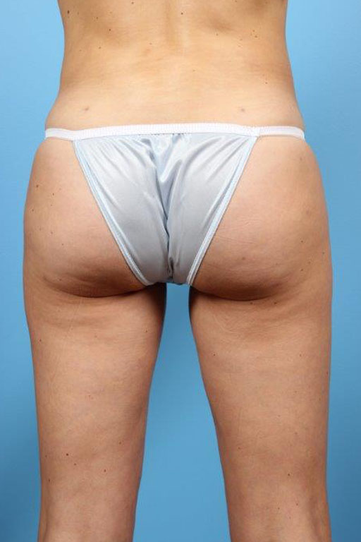 Buttock Augmentation Before and After 10