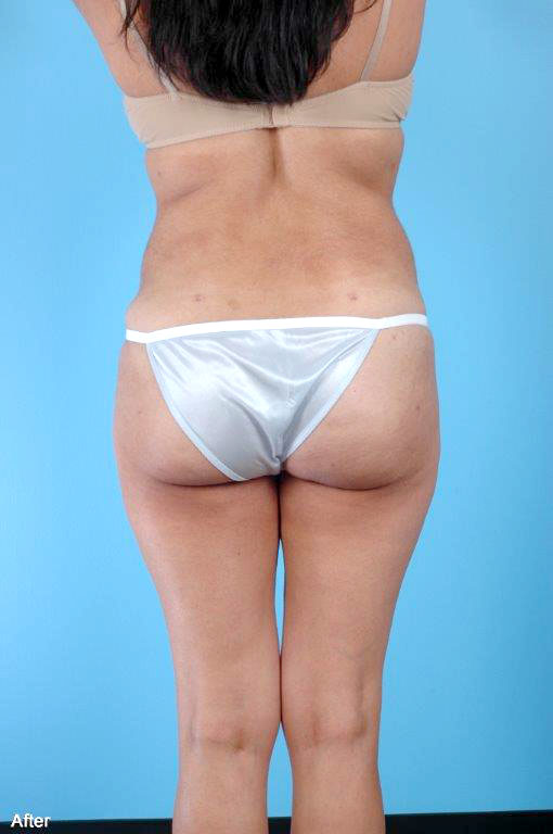 Buttock Augmentation Before and After 03