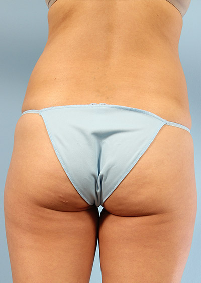 Buttock Augmentation Before and After 21