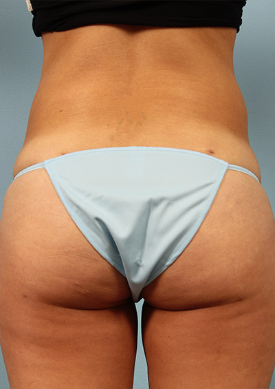 Buttock Augmentation Before and After 07