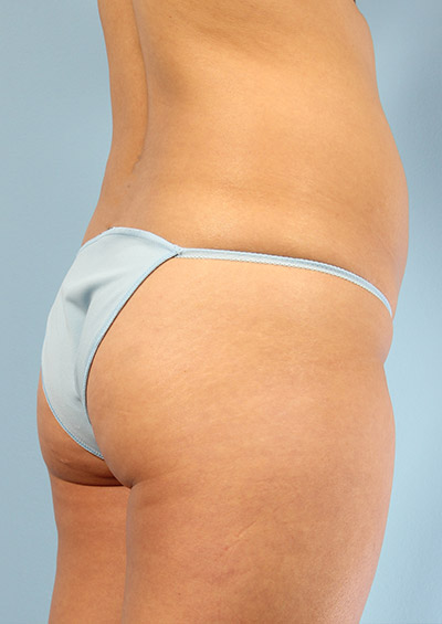 Buttock Augmentation Before and After 21