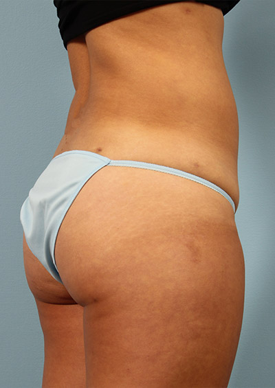 Buttock Augmentation Before and After 21