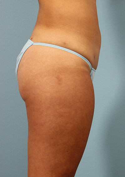 Buttock Augmentation Before and After 21