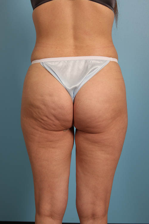 Cellfina Cellulite Reduction Before and After 04