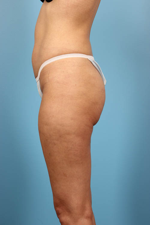 Cellfina Cellulite Reduction Before and After 04