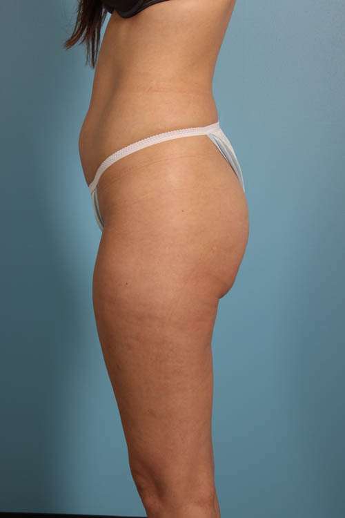 Cellfina Cellulite Reduction Before and After 04