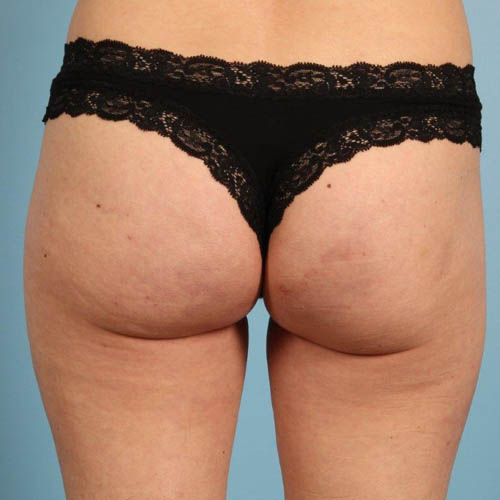 Cellfina Cellulite Reduction Before and After 01