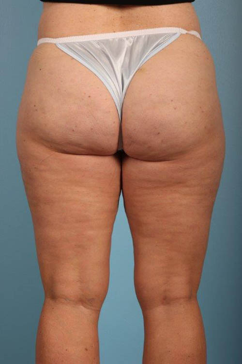 Cellfina Cellulite Reduction Before and After 10