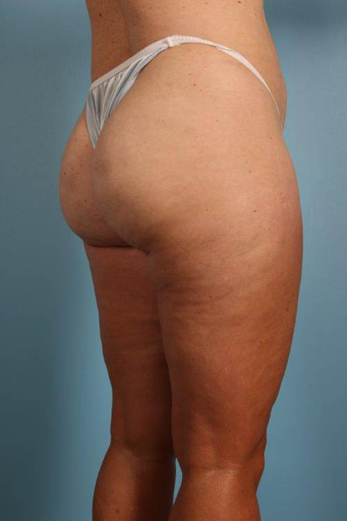 Cellfina Cellulite Reduction Before and After 06