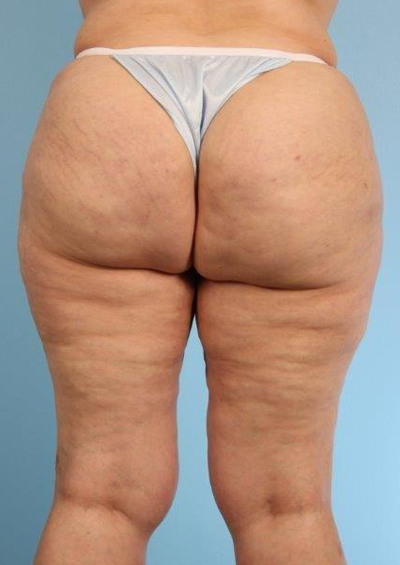 Cellfina Cellulite Reduction Before and After 03
