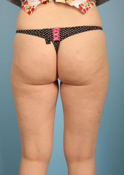 Cellfina Cellulite Reduction Before and After 10