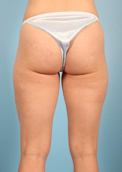 Cellfina Cellulite Reduction Before and After 02