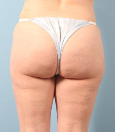 Cellfina Cellulite Reduction Before and After 01