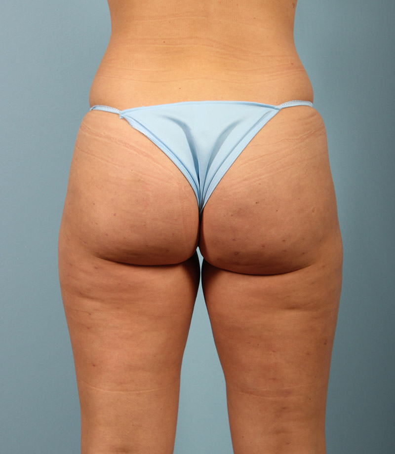 Cellfina Cellulite Reduction Before and After 03