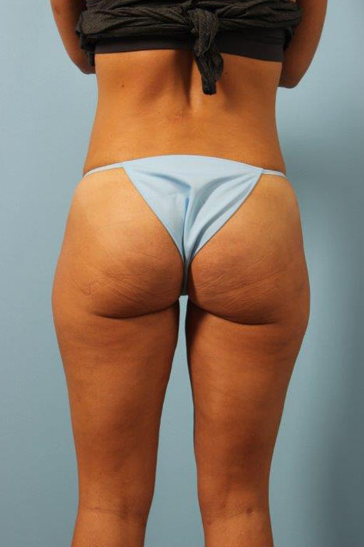 Cellfina Cellulite Reduction Before and After 05