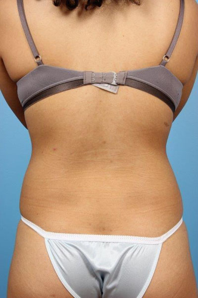 Coolsculpting Before and After 05