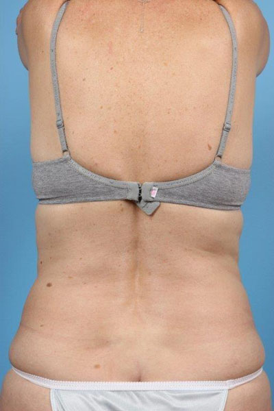 Coolsculpting Before and After 18