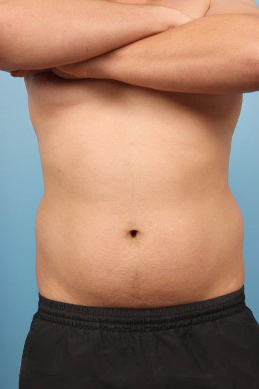 Coolsculpting Before and After 10