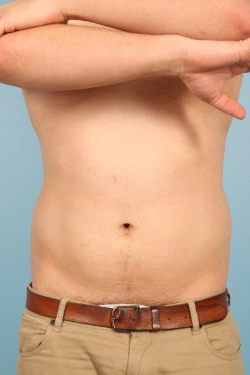 Coolsculpting Before and After 12