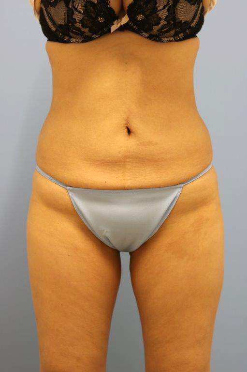 Coolsculpting Before and After 16