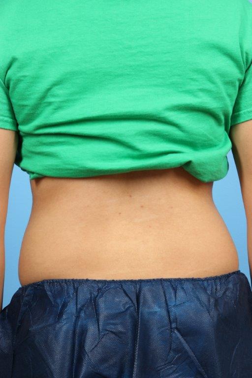 Coolsculpting Before and After 12