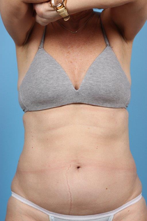 Coolsculpting Before and After 02