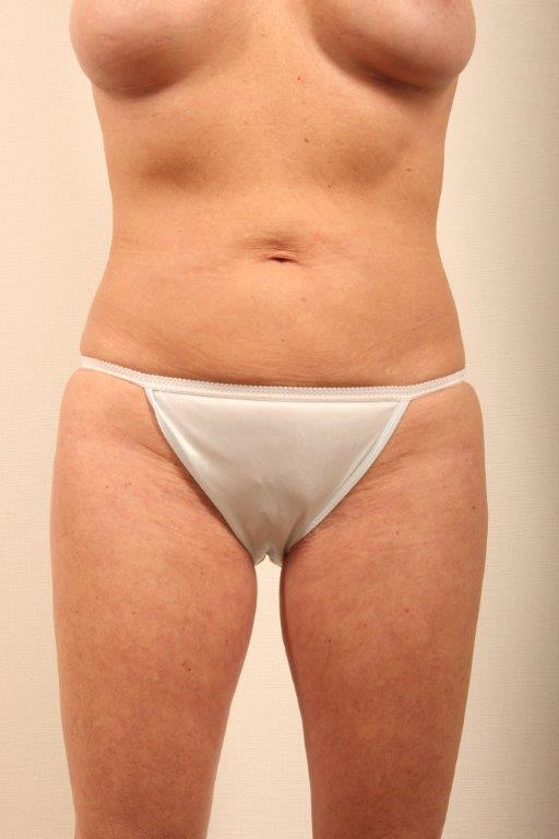 Coolsculpting Before and After 11