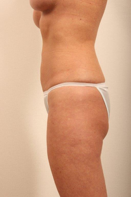 Coolsculpting Before and After 16