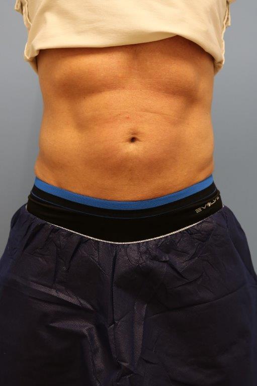 Coolsculpting Before and After 09